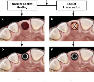 Alveolar bone dimensional changes of post-extraction sockets in humans