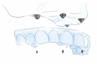 Full Arch Multi Unit Abutments